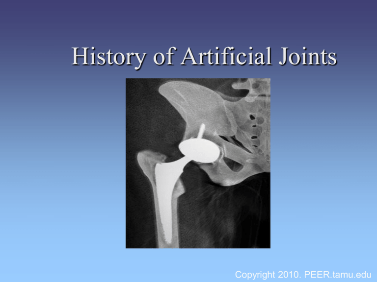 history-of-artificial-joints