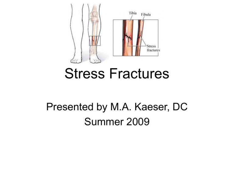 stress fractures literature review