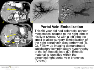 Portal Vein Embolization