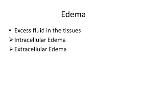 Edema - MBBS Students Club