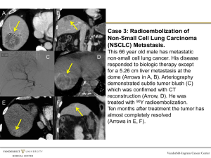 Radioembolization Segmentectomy