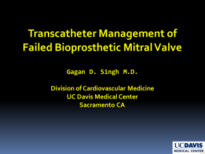 Transcatheter Management  of   Failed  Bioprosthetic Mitral  Valve Gagan D.  Singh  M.D.