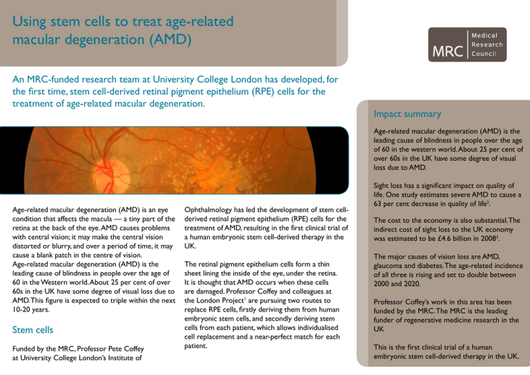 Using stem cells to treat agerelated macular degeneration (AMD)